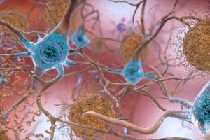 Penyakit Alzheimer Terkait Dengan Ritme Sirkadian