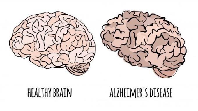 Penyakit Alzheimer Menyebabkan Perubahan Fisik Otak 